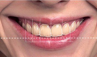 Teeth being analyzed with smile design software