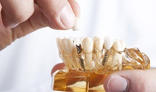 Model of smile with dental implant and dental crown