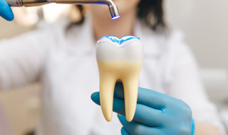Dentist showing dental bonding process on model tooth