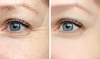 Closeup of patient's wrinkles before and after BOTOX®