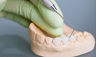 Dental bridge on a model of teeth