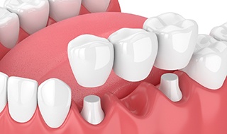 3D model of a traditional dental bridge 