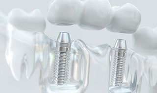 Model of an implant bridge