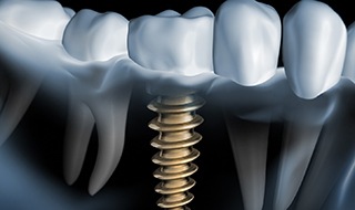 Model showing a single unit implant.