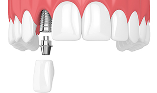 Model showing each part of a dental implant.