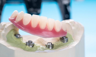 Close up of a denture resting on top of a wax dental implant model