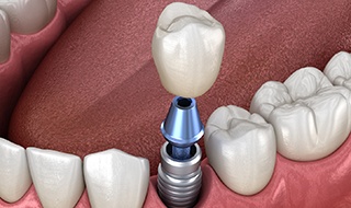 single dental implant topped with a dental crown 