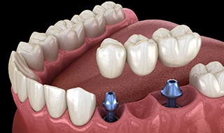 two dental implants securing a dental bridge in place 