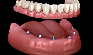 six dental implants supporting a full denture 