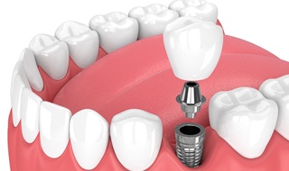 A digital image of a single tooth dental implant and all its parts sitting in the lower arch of the mouth in Burlington 