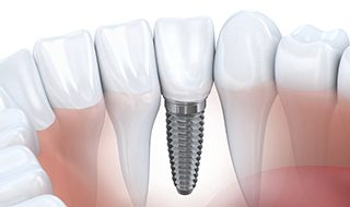 Animation of implant supported dental crown