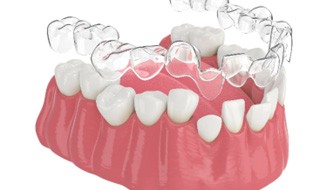Illustration of Invisalign being placed on misaligned teeth