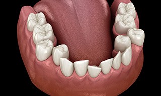 Illustration of crooked teeth