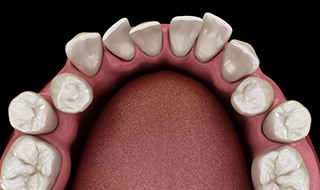 Illustration of gapped teeth