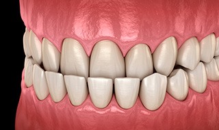 Illustration of an underbite