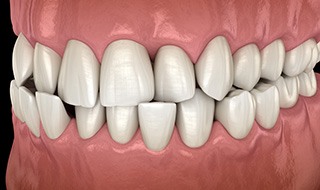 Illustration of a crossbite