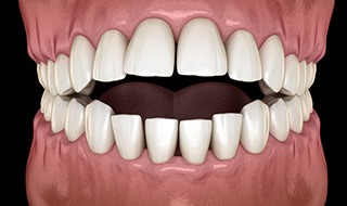 Illustration of an open bite