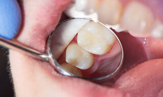 tooth colored filling on molar