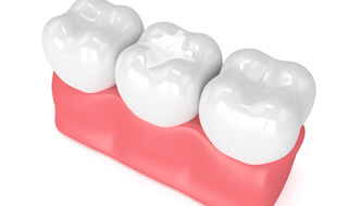 molar showing a tooth-colored filling