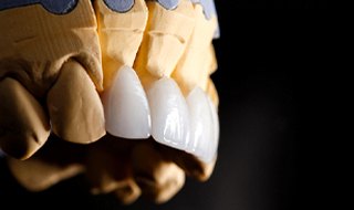 model of a mouth being fitted with porcelain veneers