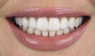 Close-up of smile after receiving veneers in Burlington, MA