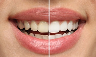 In order to understand the cost of teeth whitening, you must understand the many factors that go into determining the price