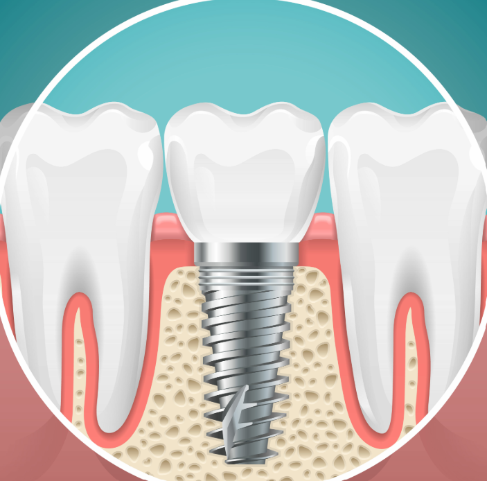 Illustrated cross section of a dental implant